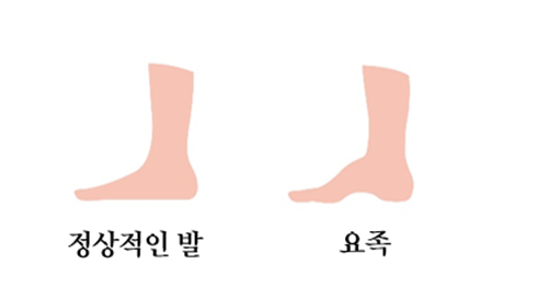 정상적인 발과 요족.