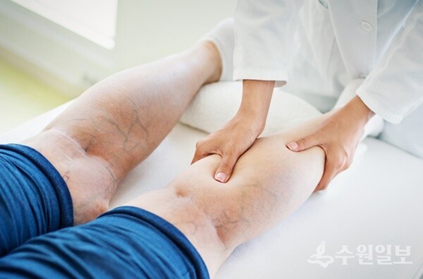무더운 여름철에는 하지정맥류 발생이 증가하고 있다. (사진=나누리병원)