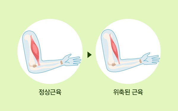 루게릭병-근위축.
